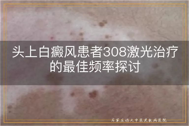 头上白癜风患者308激光治疗的最佳频率探讨