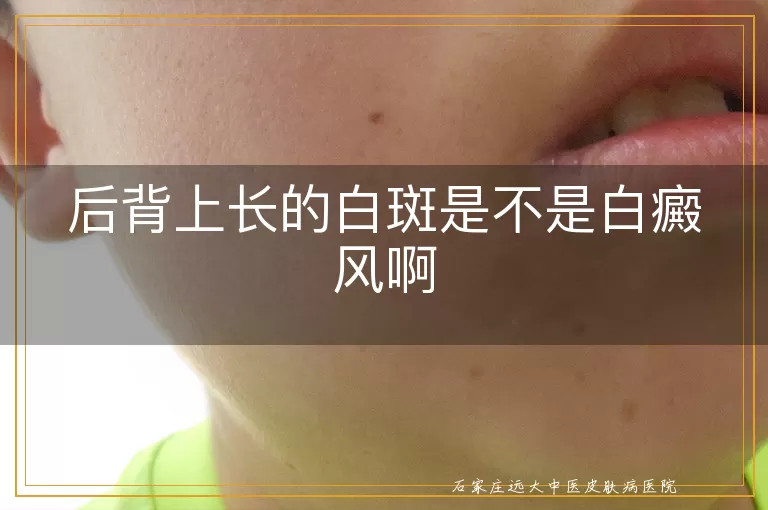 后背上长的白斑是不是白癜风啊