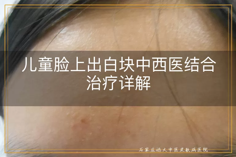 儿童脸上出白块中西医结合治疗详解