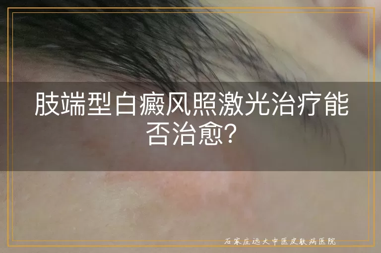 肢端型白癜风照激光治疗能否治愈？