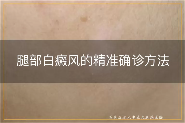 腿部白癜风的精准确诊方法