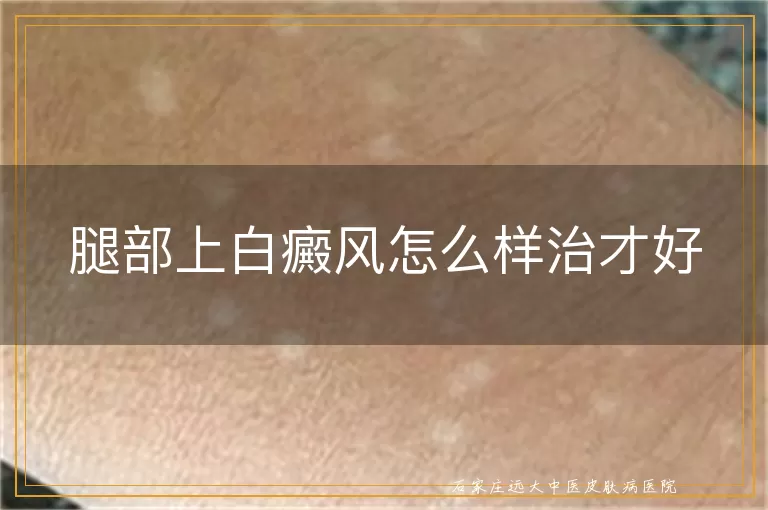 腿部上白癜风怎么样治才好