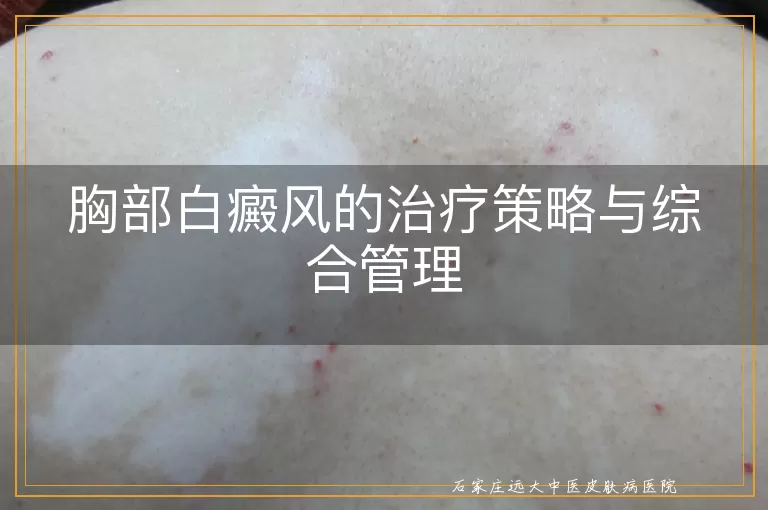 胸部白癜风的治疗策略与综合管理