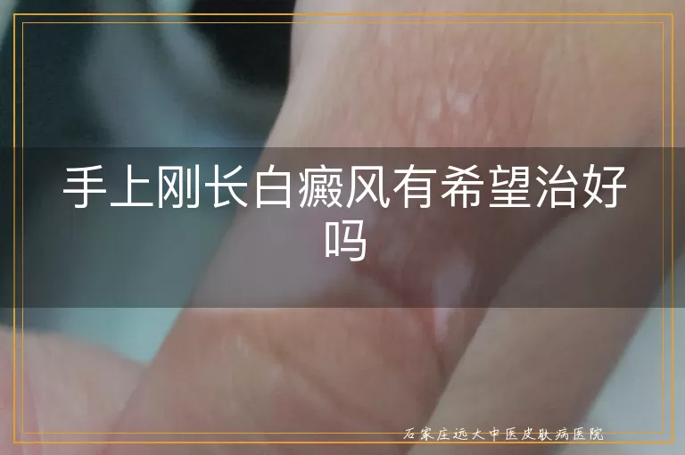 手上刚长白癜风有希望治好吗