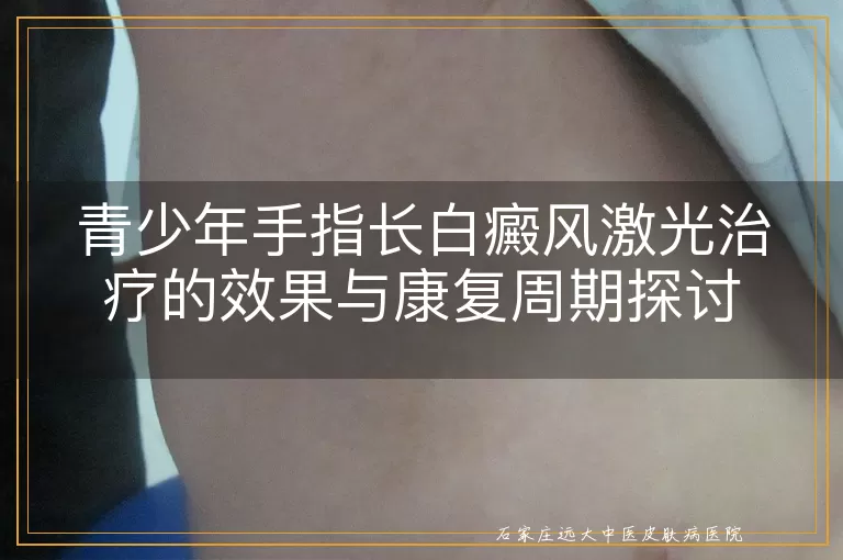 青少年手指长白癜风激光治疗的效果与康复周期探讨
