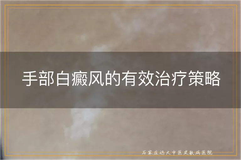 手部白癜风的有效治疗策略