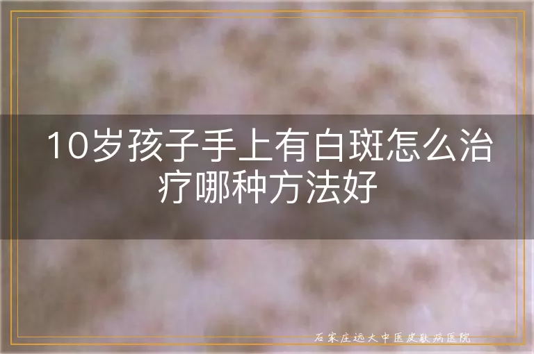 10岁孩子手上有白斑怎么治疗哪种方法好