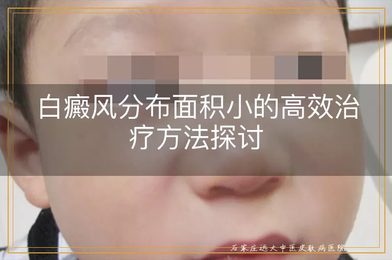 白癜风分布面积小的高效治疗方法探讨