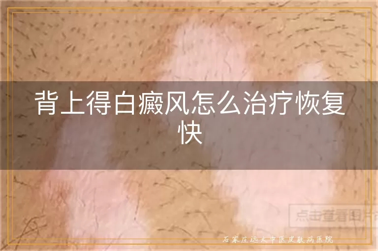 背上得白癜风怎么治疗恢复快