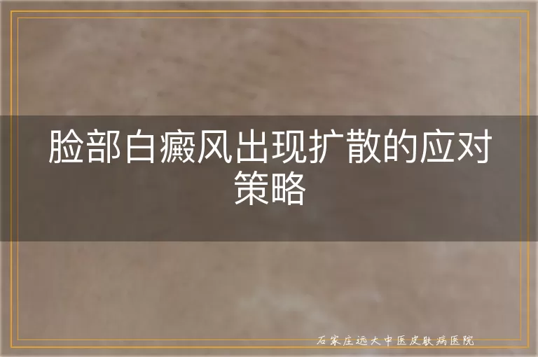 脸部白癜风出现扩散的应对策略