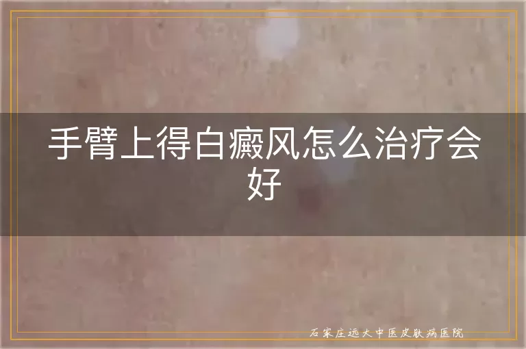 手臂上得白癜风怎么治疗会好