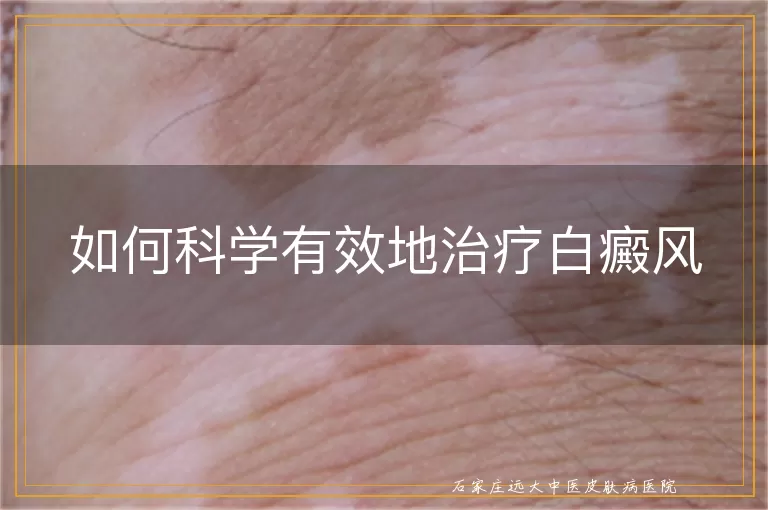 如何科学有效地治疗白癜风