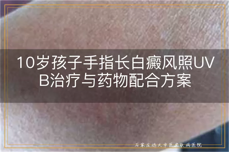 10岁孩子手指长白癜风照UVB治疗与药物配合方案