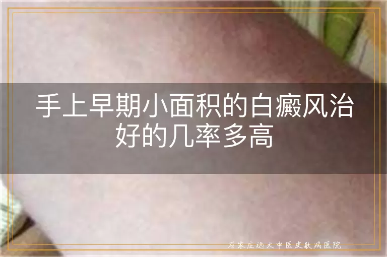 手上早期小面积的白癜风治好的几率多高