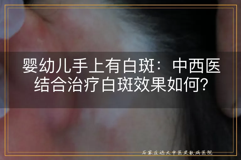 婴幼儿手上有白斑：中西医结合治疗白斑效果如何？