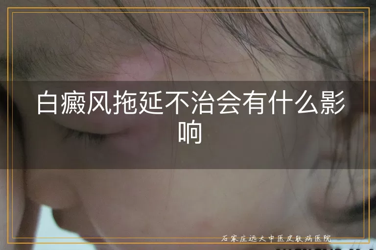 白癜风拖延不治会有什么影响