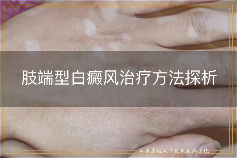 肢端型白癜风治疗方法探析