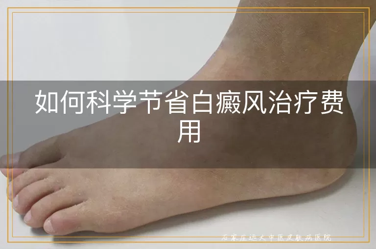 如何科学节省白癜风治疗费用