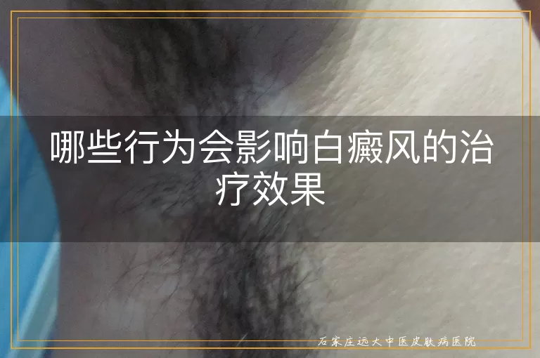 哪些行为会影响白癜风的治疗效果