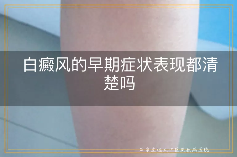 白癜风的早期症状表现都清楚吗