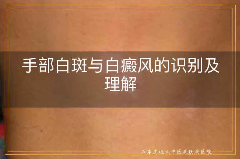 手部白斑与白癜风的识别及理解