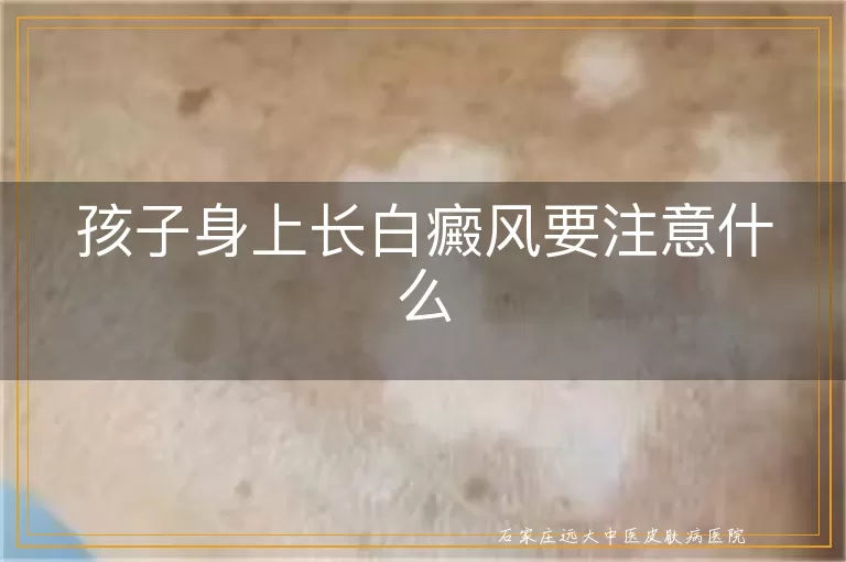 孩子身上长白癜风要注意什么