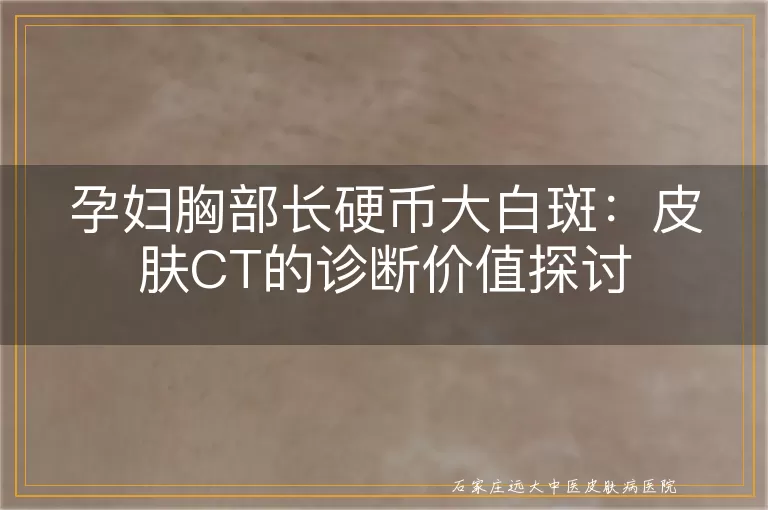 孕妇胸部长硬币大白斑：皮肤CT的诊断价值探讨
