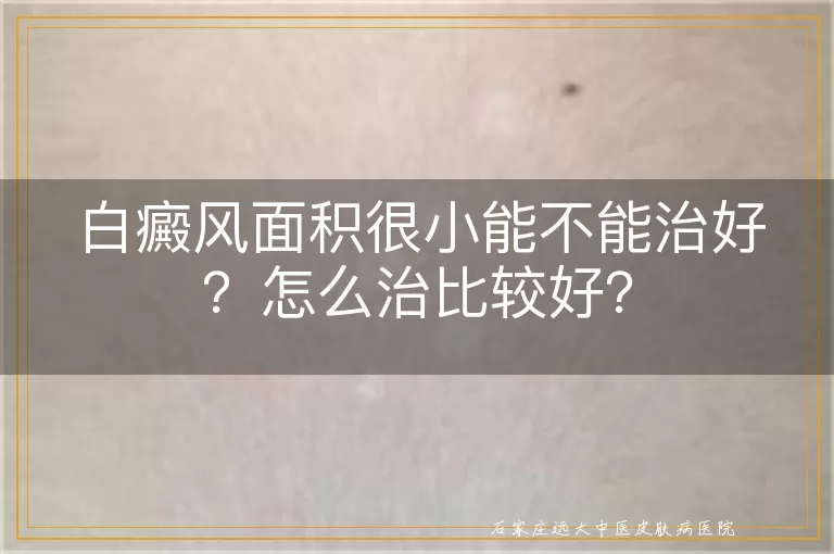 白癜风面积很小能不能治好？怎么治比较好？