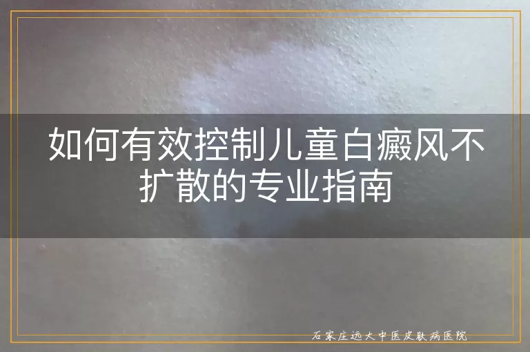 如何有效控制儿童白癜风不扩散的专业指南