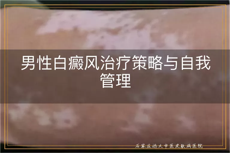 男性白癜风治疗策略与自我管理