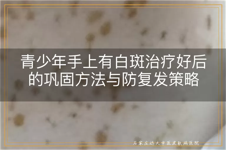 青少年手上有白斑治疗好后的巩固方法与防复发策略