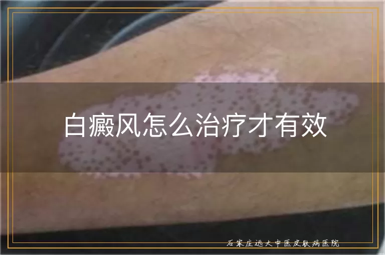 白癜风怎么治疗才有效