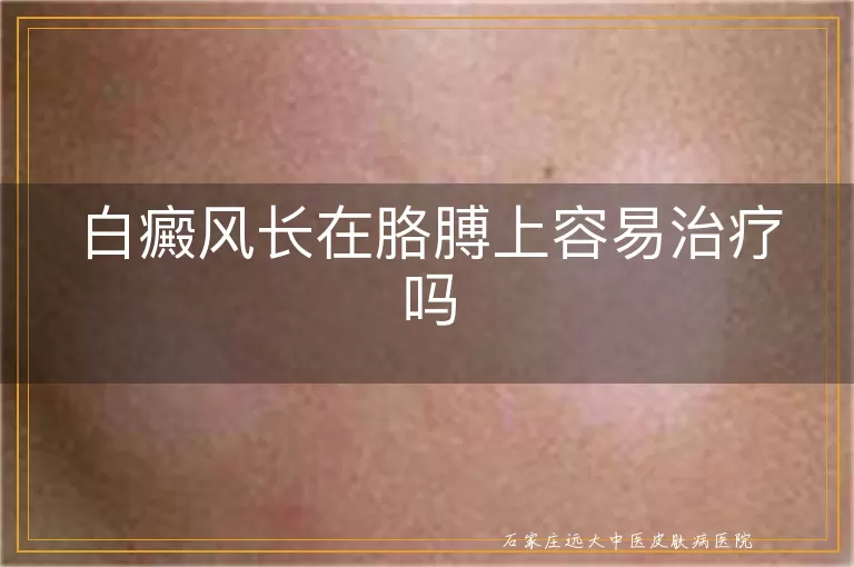 白癜风长在胳膊上容易治疗吗