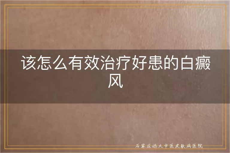 该怎么有效治疗好患的白癜风