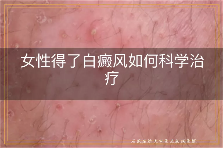女性得了白癜风如何科学治疗