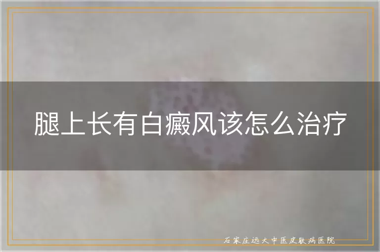 腿上长有白癜风该怎么治疗