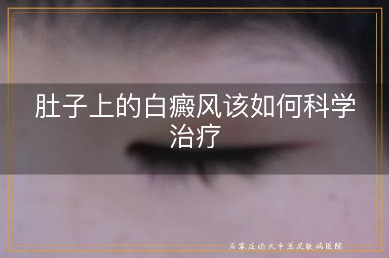 肚子上的白癜风该如何科学治疗