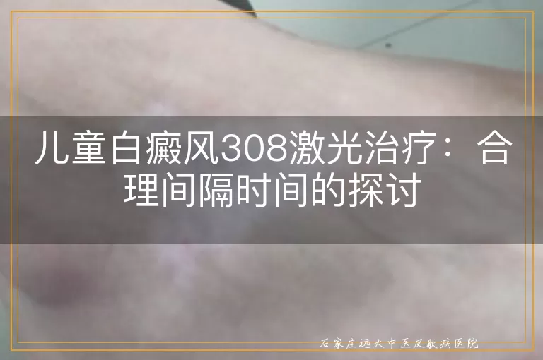 儿童白癜风308激光治疗：合理间隔时间的探讨