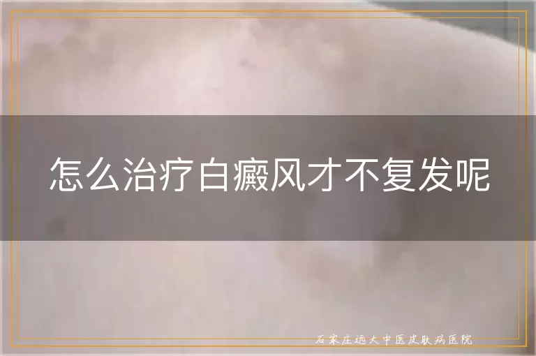 怎么治疗白癜风才不复发呢