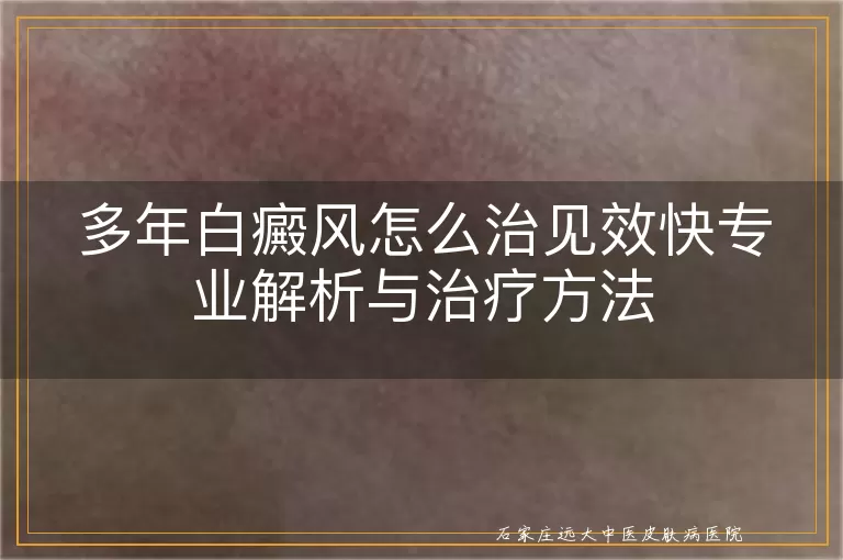 多年白癜风怎么治见效快专业解析与治疗方法