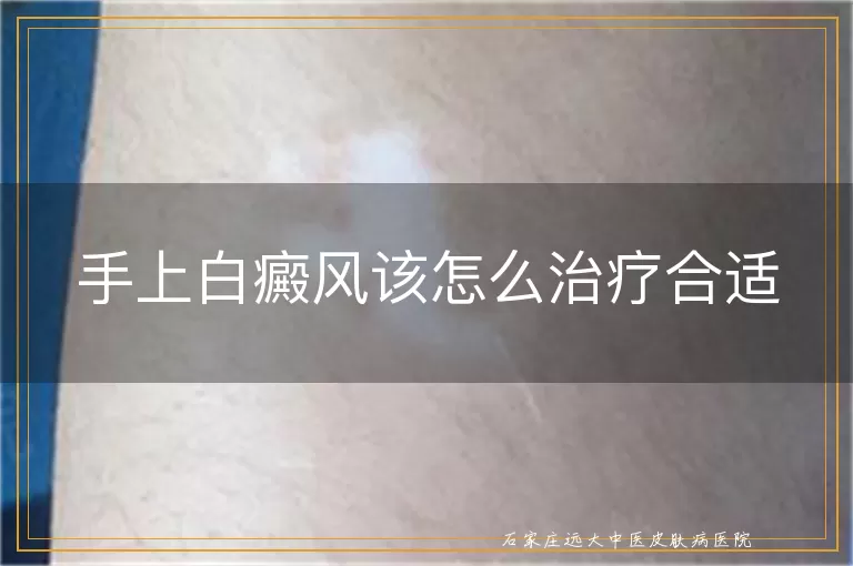 手上白癜风该怎么治疗合适