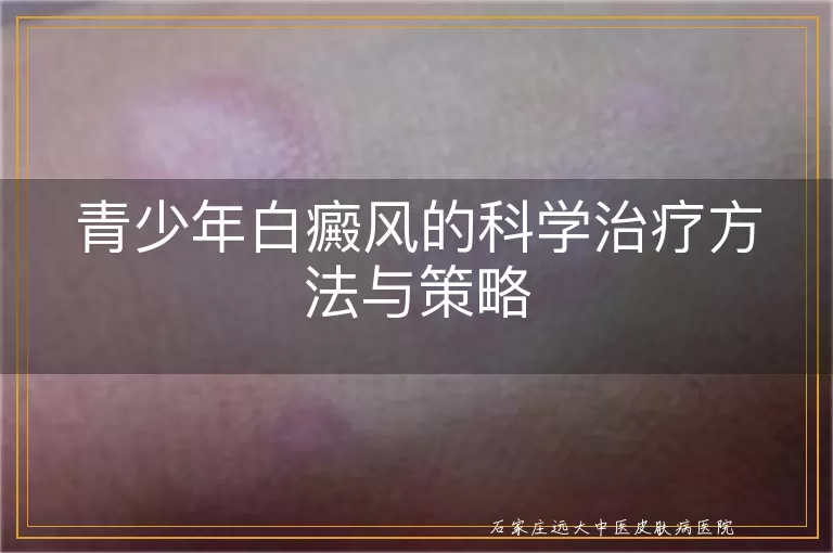 青少年白癜风的科学治疗方法与策略