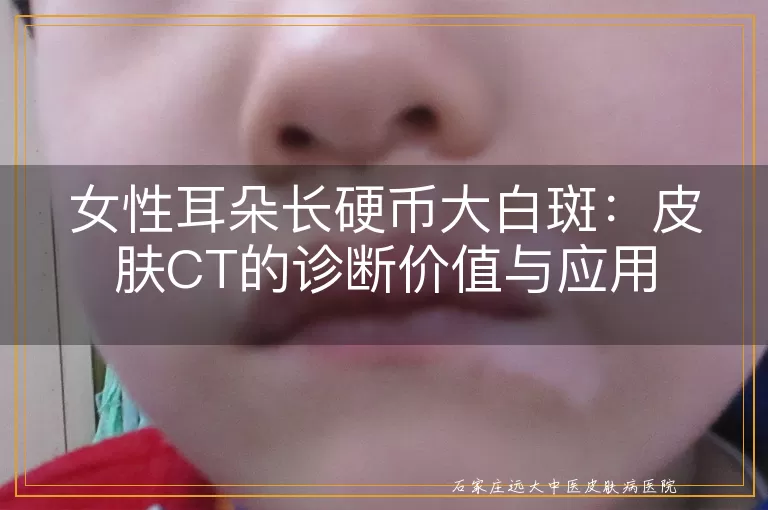 女性耳朵长硬币大白斑：皮肤CT的诊断价值与应用
