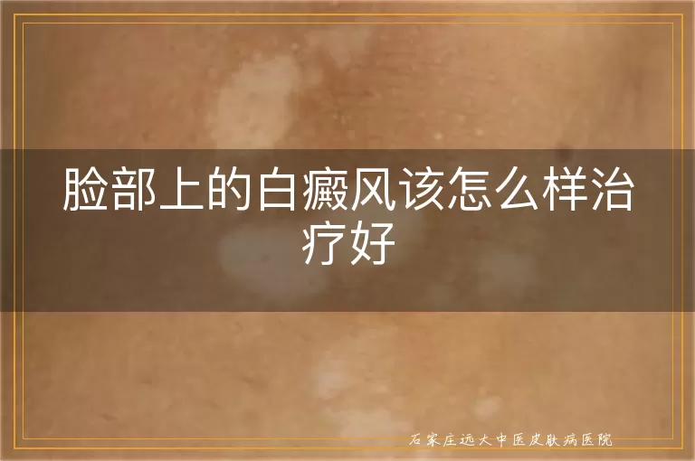 脸部上的白癜风该怎么样治疗好