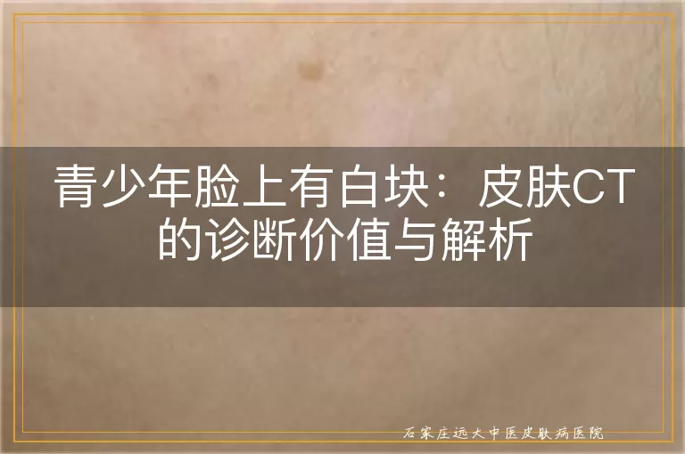 青少年脸上有白块：皮肤CT的诊断价值与解析