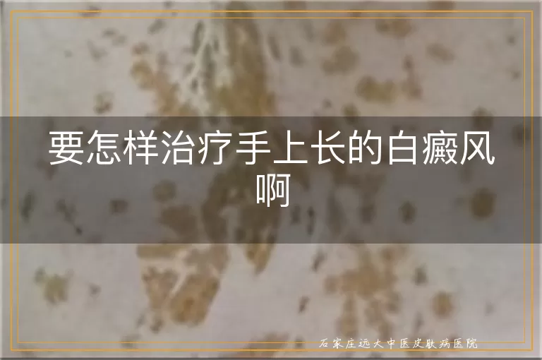 要怎样治疗手上长的白癜风啊
