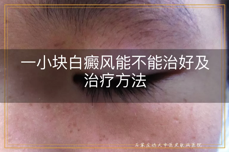 一小块白癜风能不能治好及治疗方法