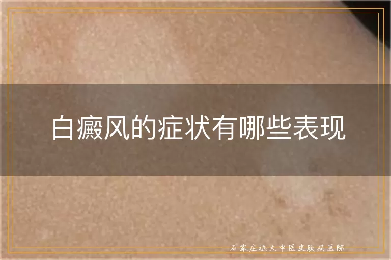 白癜风的症状有哪些表现