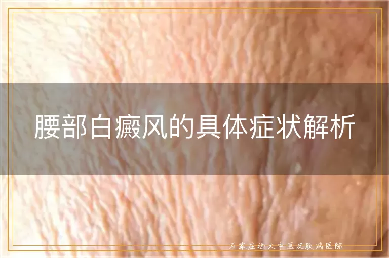 腰部白癜风的具体症状解析