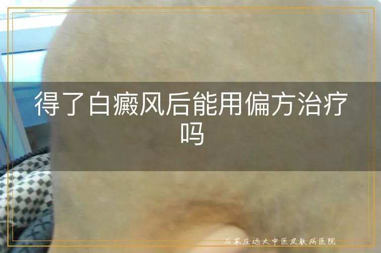 得了白癜风后能用偏方治疗吗